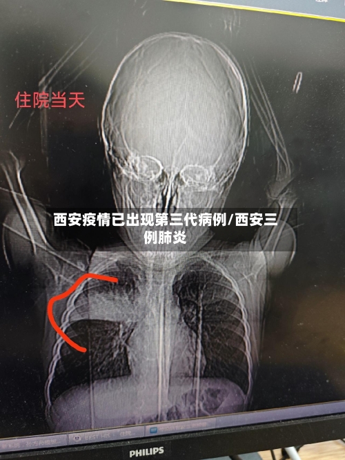 西安疫情已出现第三代病例/西安三例肺炎
