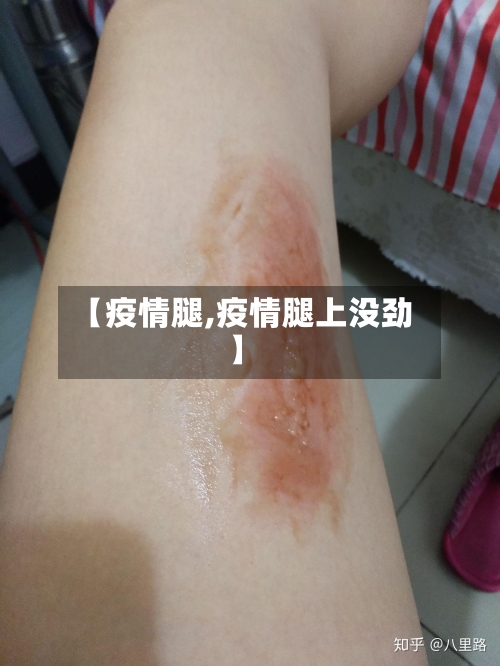 【疫情腿,疫情腿上没劲】