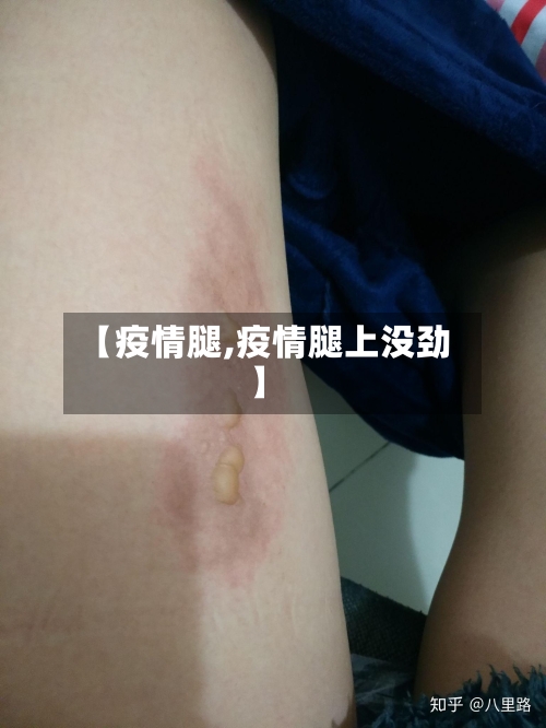 【疫情腿,疫情腿上没劲】-第2张图片